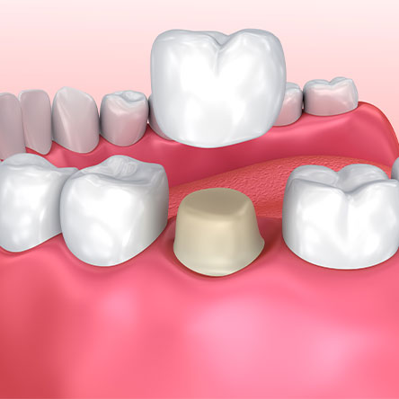 illustration of a dental crown procedure